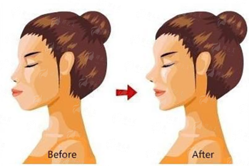 <strong>二、<strong>假体丰臀的优点和缺点是什么？在上海华美如何权衡？</strong></strong>