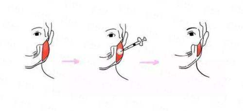 <strong>二、重庆当代肖文明医生详解：双眼皮术式怎么选才不踩坑？</strong>