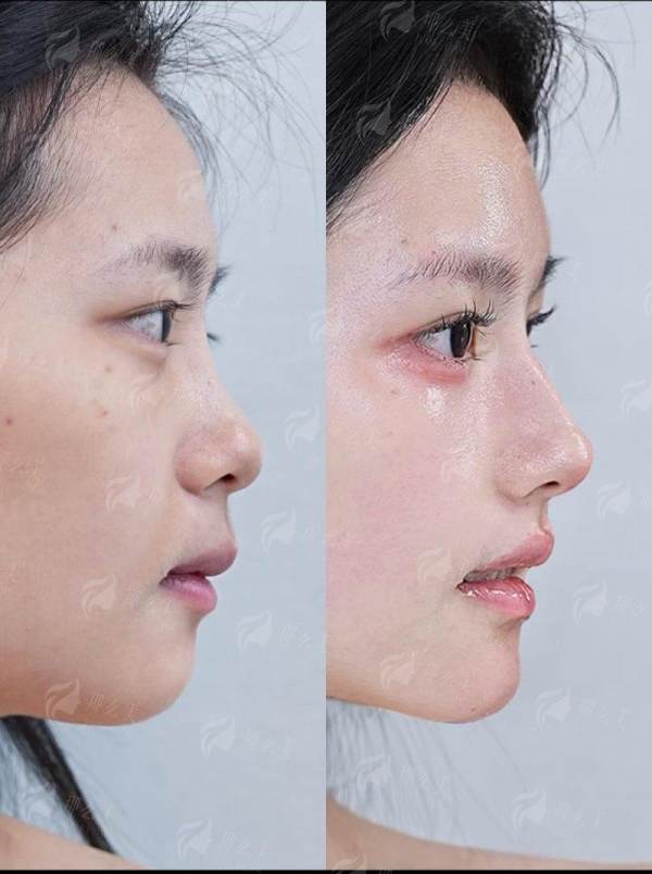 <strong>三、上海联合丽格医疗美容的李鸿君肋骨鼻，如何预约面诊？</strong>