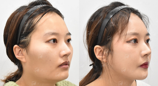 <strong>二、上海联合丽格医疗美容的李鸿君肋骨鼻，价格贵吗？</strong>