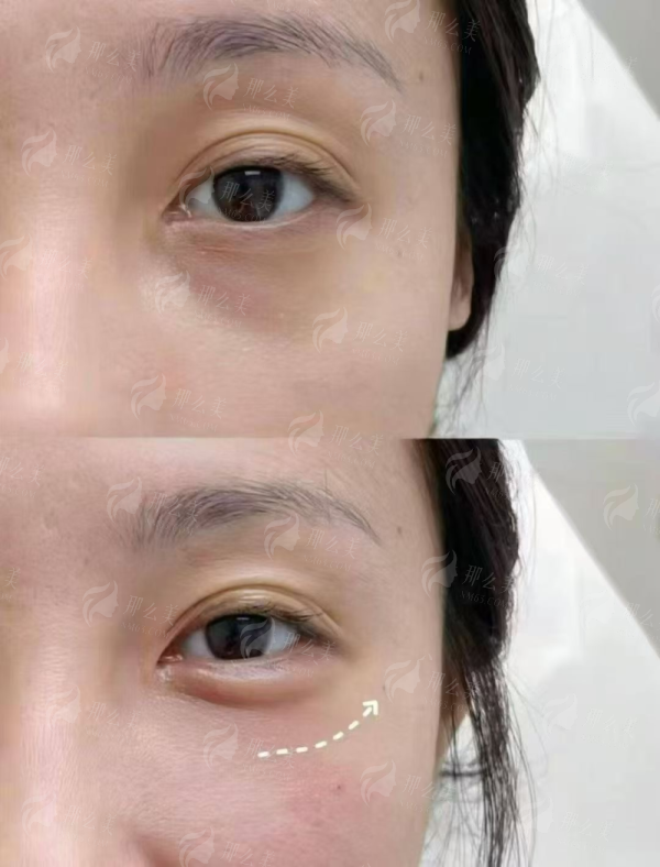 <strong>二、深圳富华唐新辉院长的隆胸技术优势在哪里？</strong>