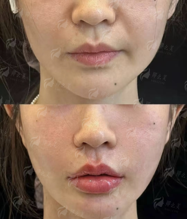 <strong>三、<strong>假体隆鼻做的怎么样？星辰瑰丽的特色技术与流程保护</strong></strong>