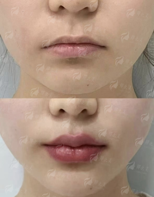 <strong>三、在贵阳华医疤痕科进行重度妊娠纹修复的流程与价格如何？</strong>