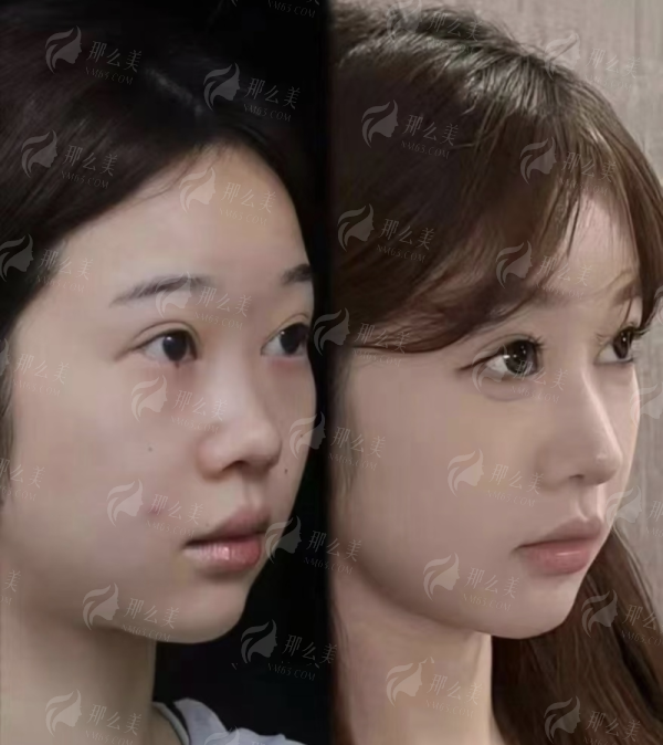 <strong>四、开眼角术后护理与注意事项有哪些？</strong>