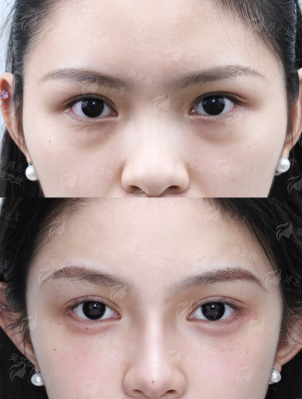 <strong>三、在广州做下巴截骨术，价格和修复期是怎样的？</strong>