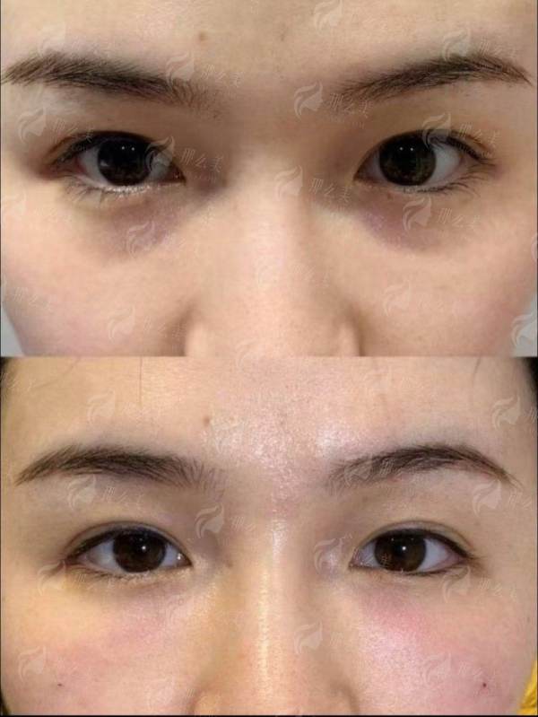 上海联合丽格医疗美容李鸿君医生，肋骨鼻个性化定制，新颜智尚小程序一键预约看案例