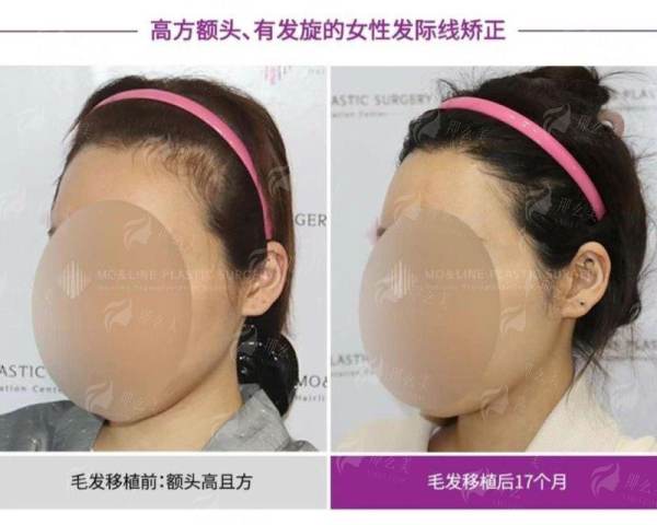 <strong>二、运城华美整形门诊部史睿凡医生的光子嫩肤成效如何保护？</strong>
