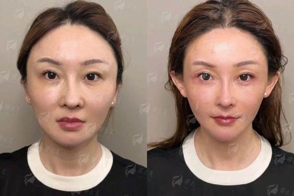 <strong>李燕双眼皮的口碑与真实实例反馈靠谱吗？</strong>
