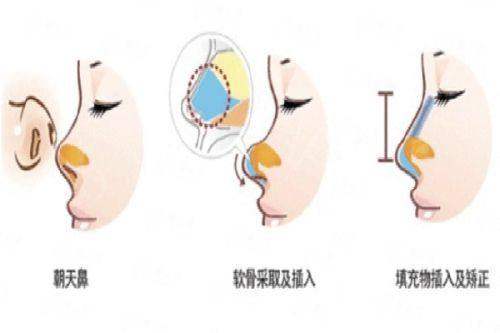 <strong>三、<strong>在北京童仁医疗美容做埋线提升，成效和价格如何？</strong></strong>