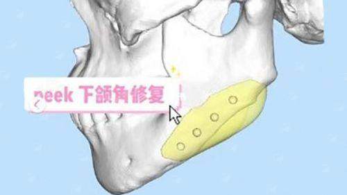 <strong>二、沈阳名流整形医院王旭院长的隆鼻技术又有哪些侧重？</strong>
