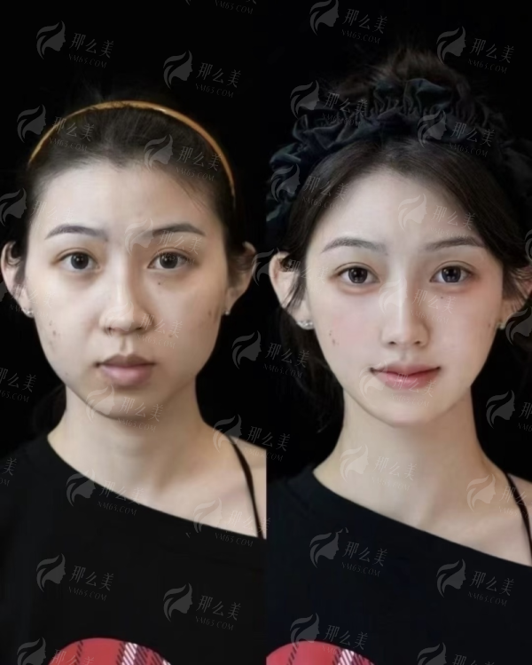 <strong>二、<strong>北京童仁医疗美容的埋线提升适合哪些美亲？</strong></strong>