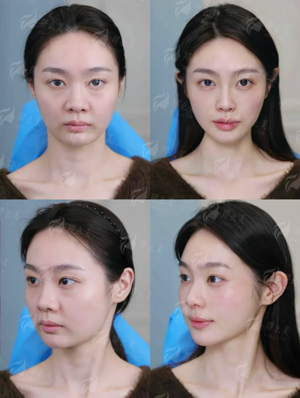 沈阳鼻综合选择指南：王松隆鼻vs王旭隆鼻，新颜智尚小程序预约享面诊优惠