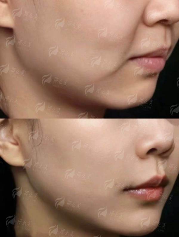 <strong>三、齐敏医生拉皮手术的口碑和术后成效如何？北京惠合嘉美医疗美容的服务贴心吗？</strong>