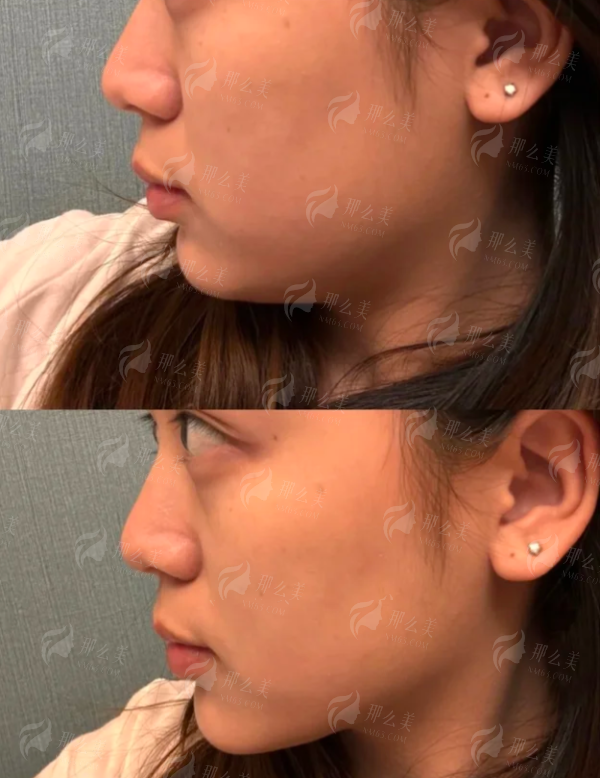 <strong>从预约到术后：在段焘医生处进行鼻修复的全流程服务体验</strong>