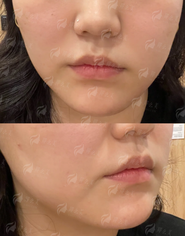 <strong>二、新疆黎美整形美容的大腿吸脂医生团队靠谱吗？</strong>