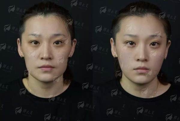 <strong>四、如何选择与预约新疆黎美整形美容的大腿吸脂？</strong>