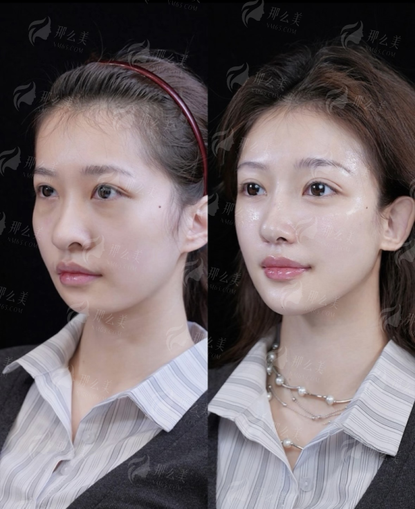 <strong>求美者更关心：李烈全身吸脂价格与收费详解</strong>