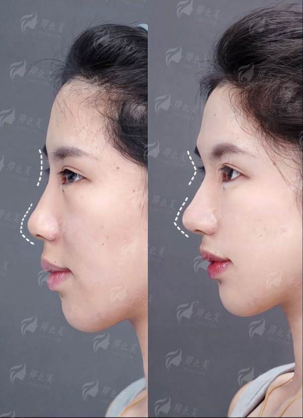 <strong>北京米扬丽格美鼻的特色项目与仪器支持</strong>