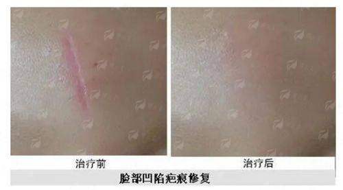 <strong>三、<strong>郑州新美颜整形王俊民馒化脸修复的价格与流程是怎样的？</strong></strong>