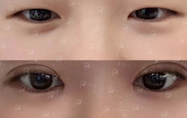 <strong>四、<strong>如何预约长沙祺美的李成医生内窥镜隆胸面诊？</strong></strong>