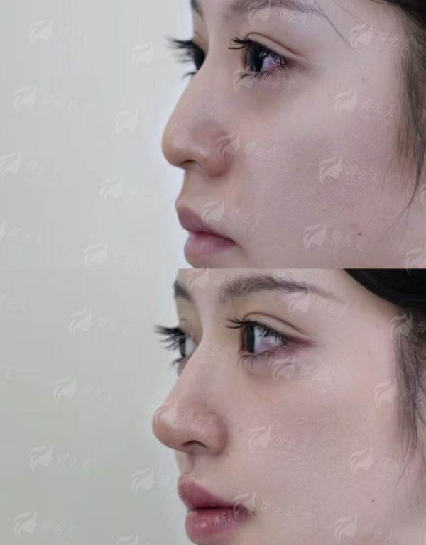 <strong>北京陈思羽隆鼻的口碑与真实患者评价如何?</strong>