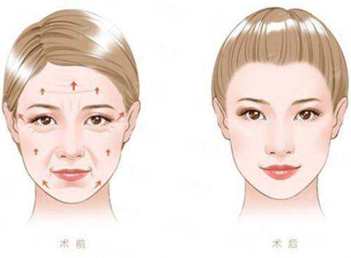 三、珠海雅媛双眼皮手术四大风格优势对比