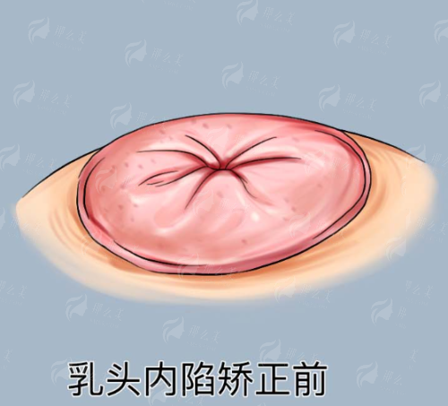 <strong>三、在江西景德镇华瑞美容做祛眼袋，术前术后要注意什么？</strong>