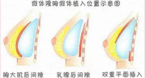 义乌艺星杨勇内窥镜丰胸怎么约？新颜智尚小程序预约，看价格优惠攻略与案例