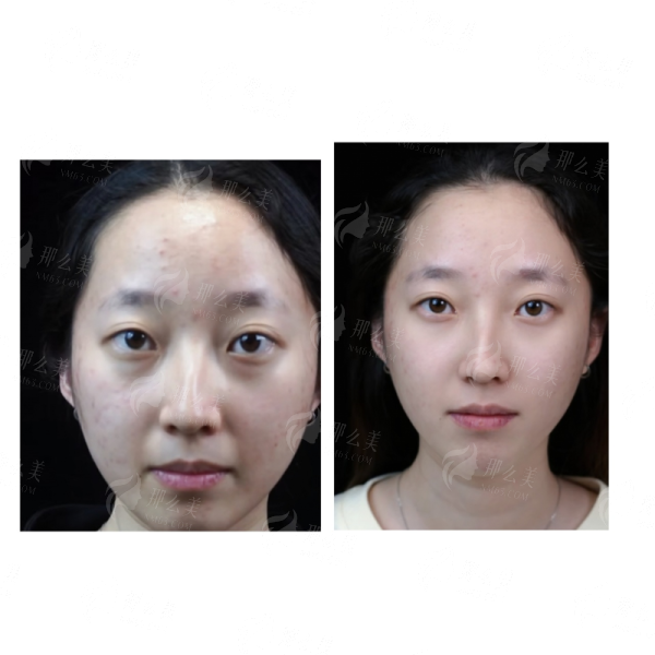 <strong>四、<strong>找李芯医生做双眼皮，如何预约与准备？</strong></strong>