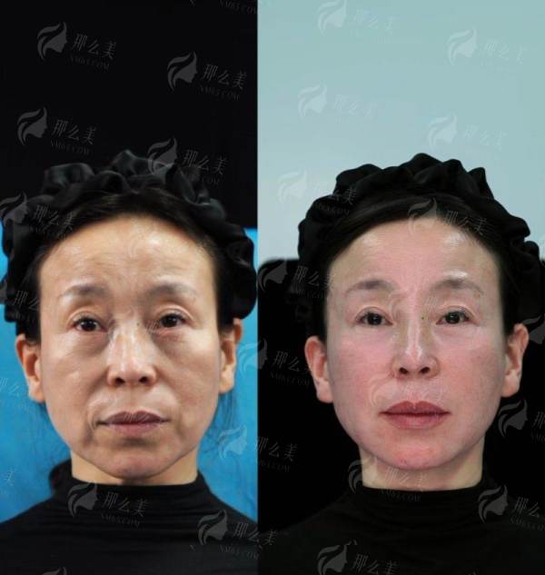 <strong>总结:为什么值得选择北京加减美黄寅守拉皮?</strong>