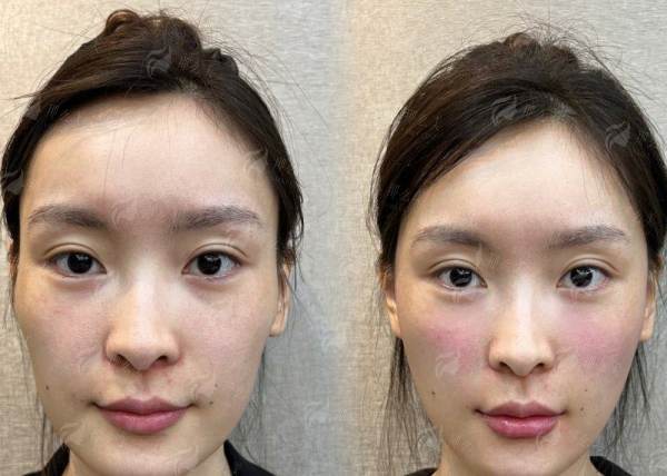 河南濮阳张大夫整形：假体隆鼻价格了解与案例推荐，新颜智尚小程序一键预约