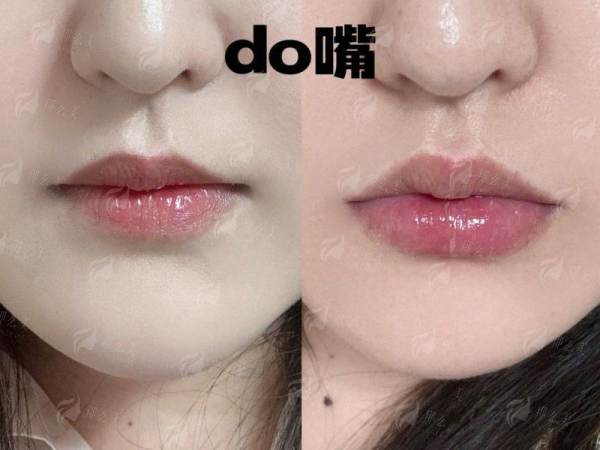 <strong>三、<strong>长沙祺美李成医生内窥镜隆胸的价格与长沙市场对比</strong></strong>