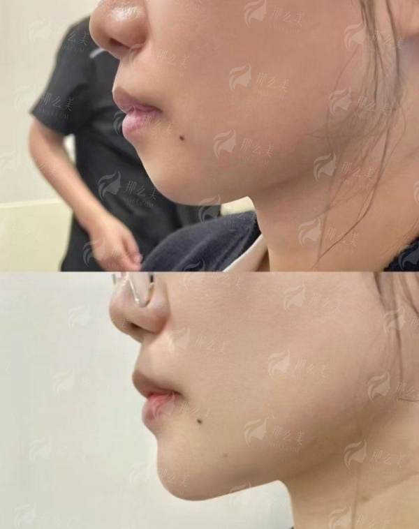 <strong>二、<strong>成都友谊医院做疤痕修复，过程体验和成效怎么样？</strong></strong>