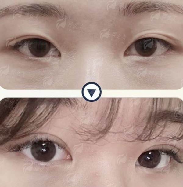 张球竣医生双眼皮案例推荐，广州曙光医院介绍，新颜智尚小程序轻松约