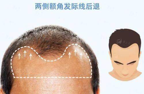 <strong>假体隆胸面诊与手术流程是怎样的？</strong>