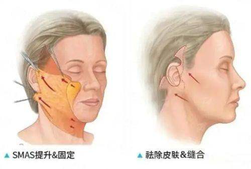 <strong>二、<strong>在江苏南通星际医疗美容做线提升，价格贵不贵？</strong></strong>
