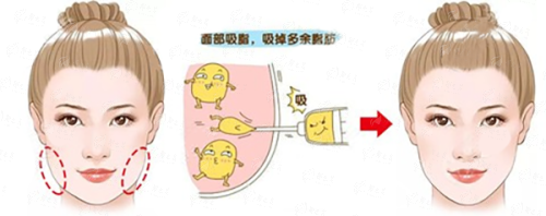 <strong>四、如何选择与预约南宁帕拉美整形的吸脂塑形?</strong>