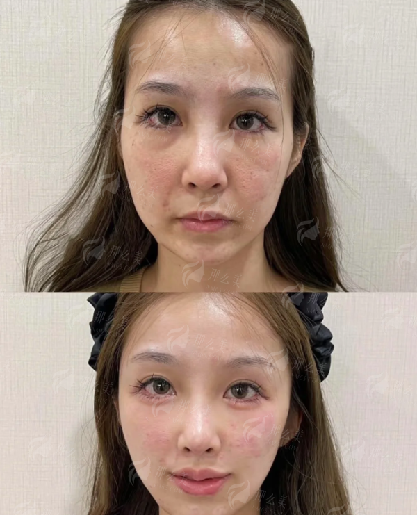 <strong>四、如何预约广东清远时光医疗美容的线提升提升面诊？</strong>