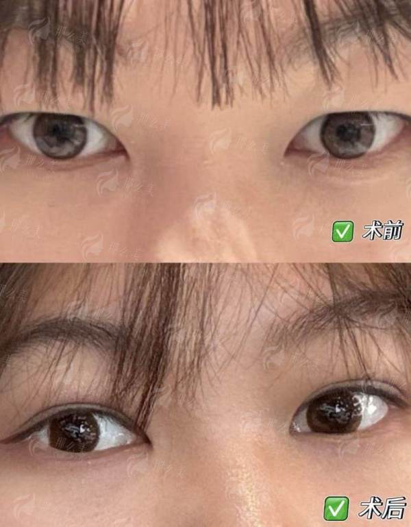 <strong>二、于艳菊医生治疗疤痕的真实实例与成效，在武汉美莱能体验到吗？</strong>