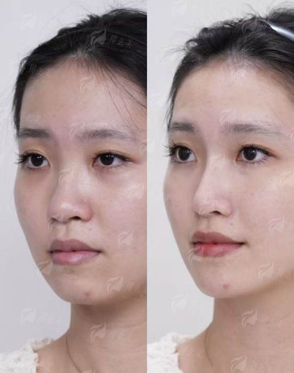 上海华美李健医生做鼻子怎么样？脊状肋软骨专利鼻整形不位移不变形，医生简介&风格优势特点-新颜智尚小程序一键预约！