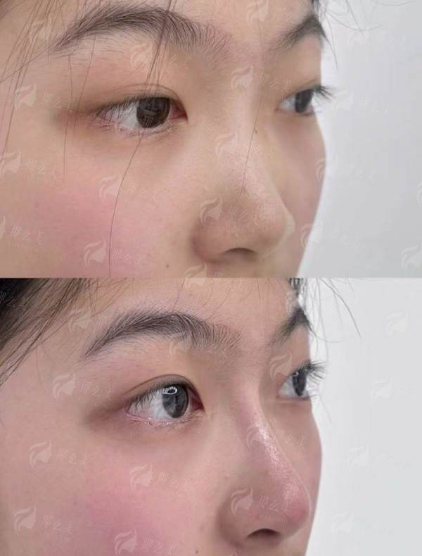 <strong>三、对比其他选择,在武汉光泽皇后整形找沈海林院长做双眼皮有什么优势?</strong>