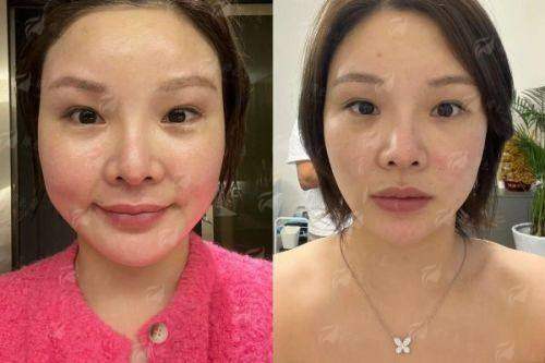 <strong>在北京画美做向往眼部整形,术后护理有哪些必须遵守的要点?</strong>
