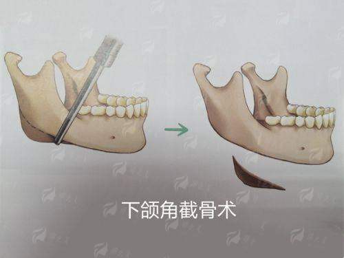 <strong style="color: rgb(255, 0, 0);">三、 重庆华美徐君双眼皮有哪些特色治疗方式与仪器?</strong>