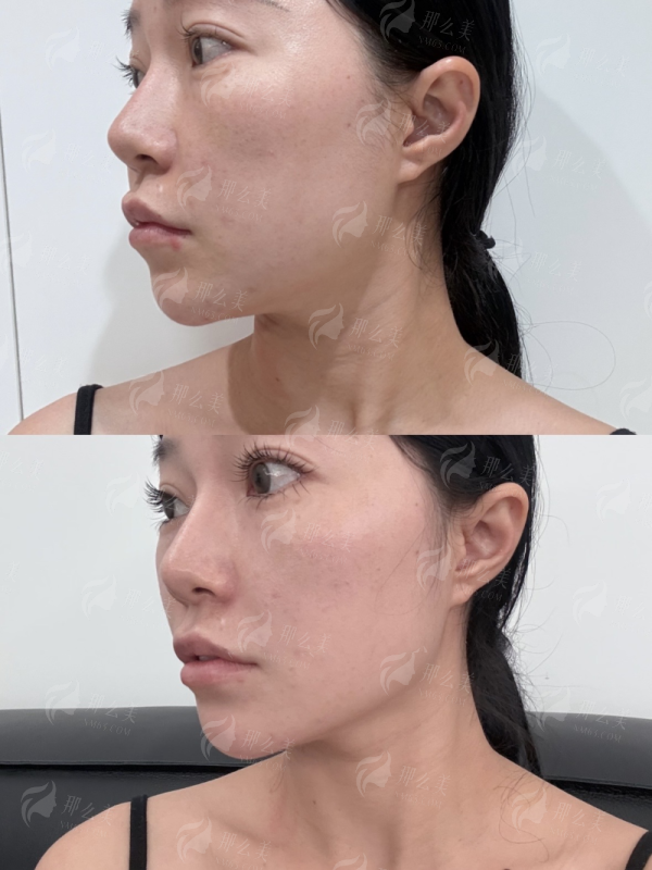 <strong>重庆华美整形外科医院毕建军双眼皮手术用的仪器有何讲究?</strong>