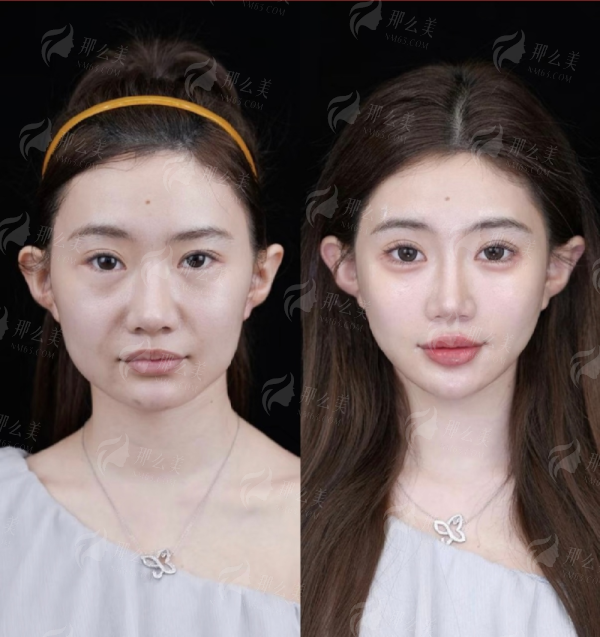<strong>深圳宝丽李信峰隆鼻的价格与收费标准</strong>