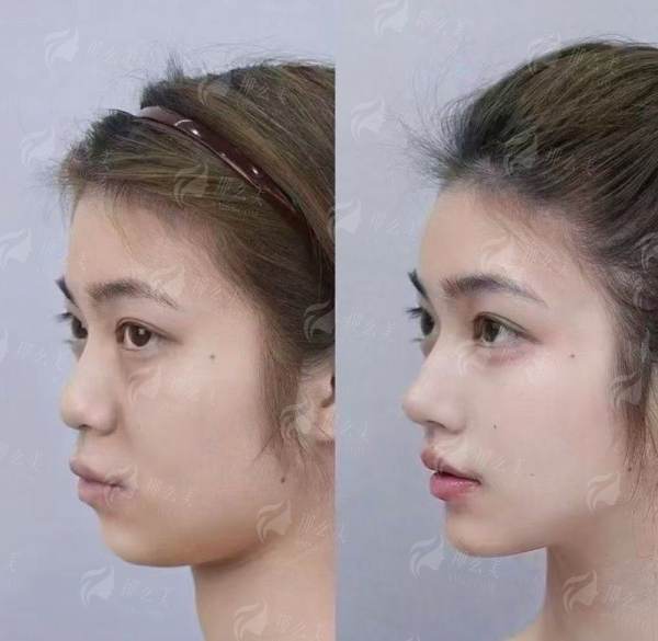 <strong>揭秘赵映贤医生的特色眼部整形技术与优势</strong>