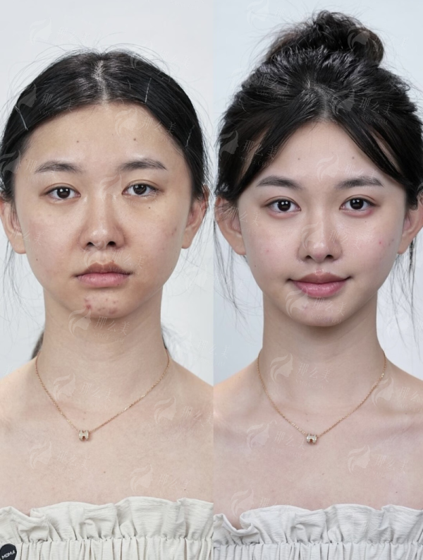 <strong>重庆华美整形外科医院假体隆胸的价格区间与收费构成</strong>