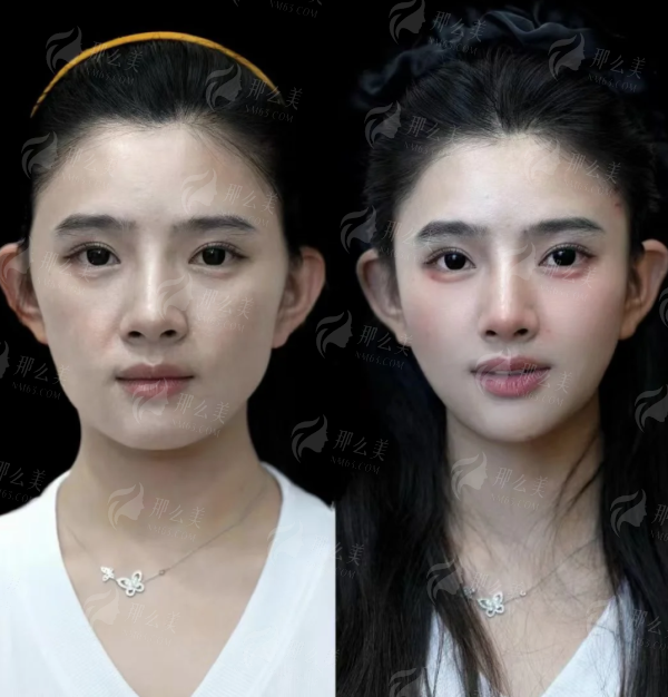 <strong>合肥画美微整科:口周年轻化特色仪器与疗法解析</strong>