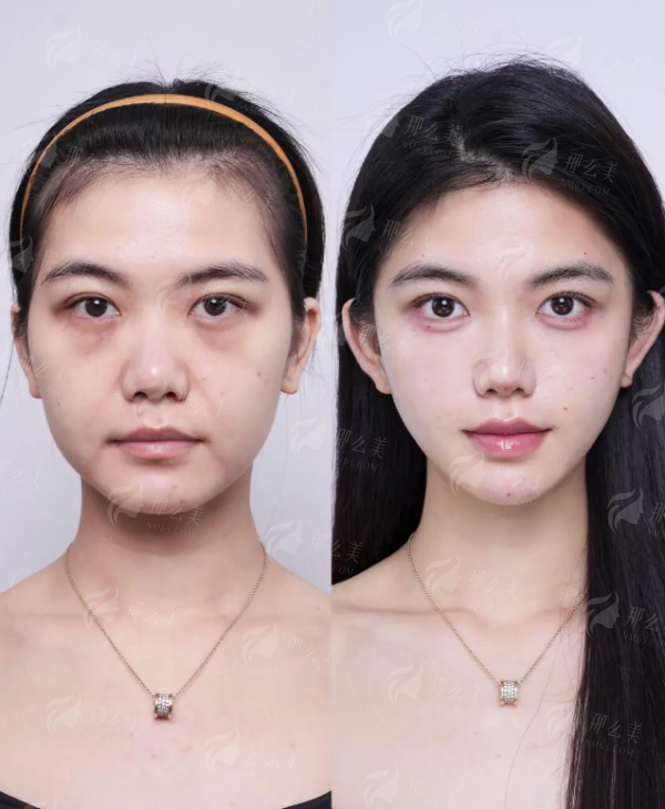 <strong>重庆华美整形外科医院方红梅和朱兴菊双眼皮谁更自然?全方面剖析朱兴菊医生的美学理念</strong>