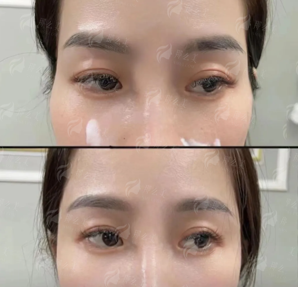 <strong>总结:为何选择北京画美实现您的眼部向往?</strong>